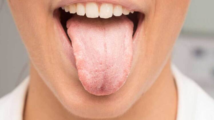 بررسی دلایل خشکی دهان از نظر طب سنتی | روش های درمان خشکی دهان